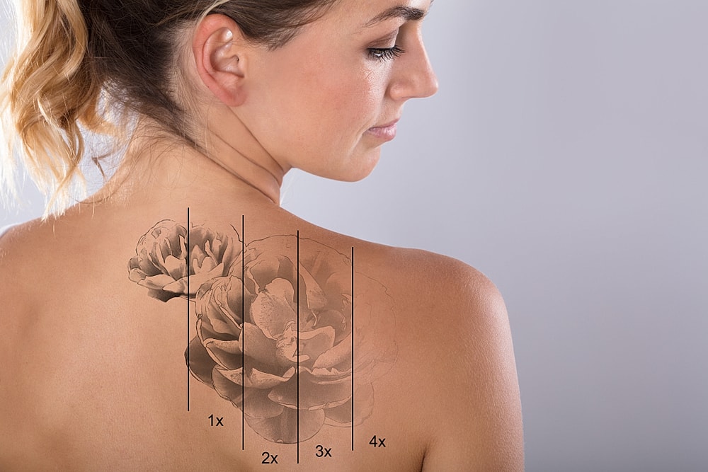 A Deep Dive: How Effective Is Laser Tattoo Removal?