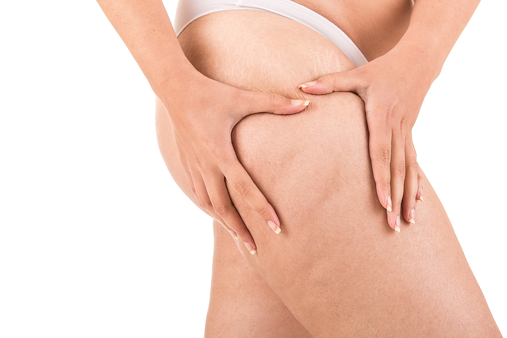 How Effective Is Cellulite Reduction?