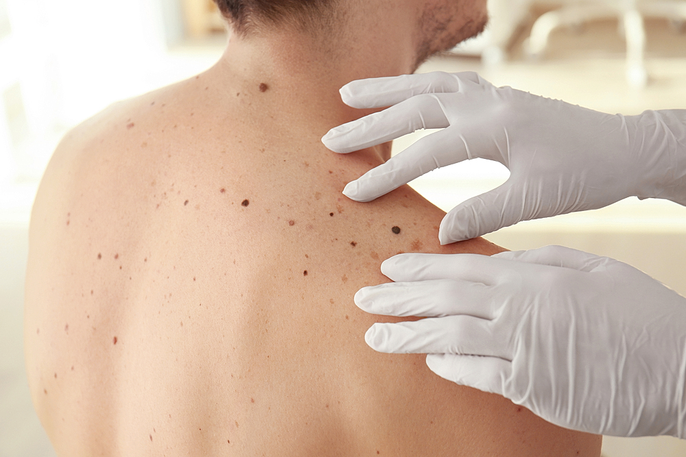 How Much Does it Cost to Remove a Mole With a Laser?