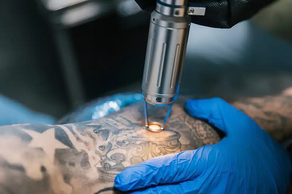 Laser Tattoo Removal – How Does it Work?