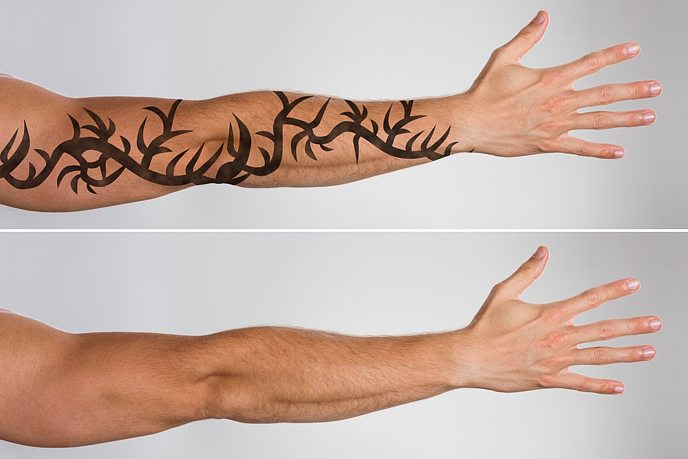 Laser Tattoo Removal: How Long Does it Take to See Results?