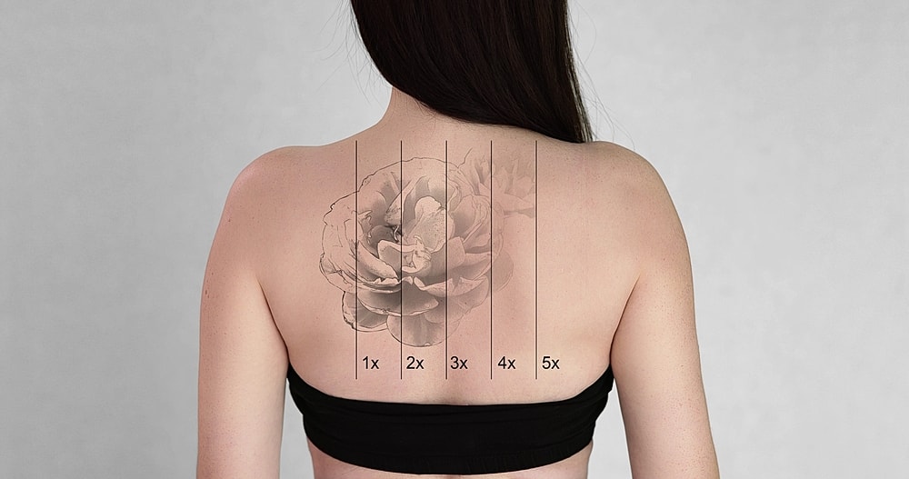 Tattoo Be Gone: How Many Tattoo Removal Sessions Does it Really Take?