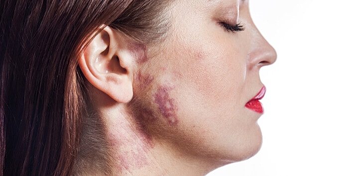Understanding the Port Wine Stain