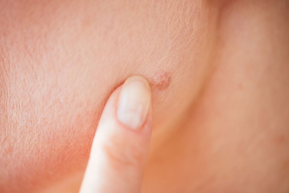 What Can Laser Moles Removal Do for You? Know the Benefits of this.