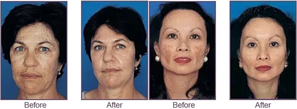 Before and after cosmetic transformation images.