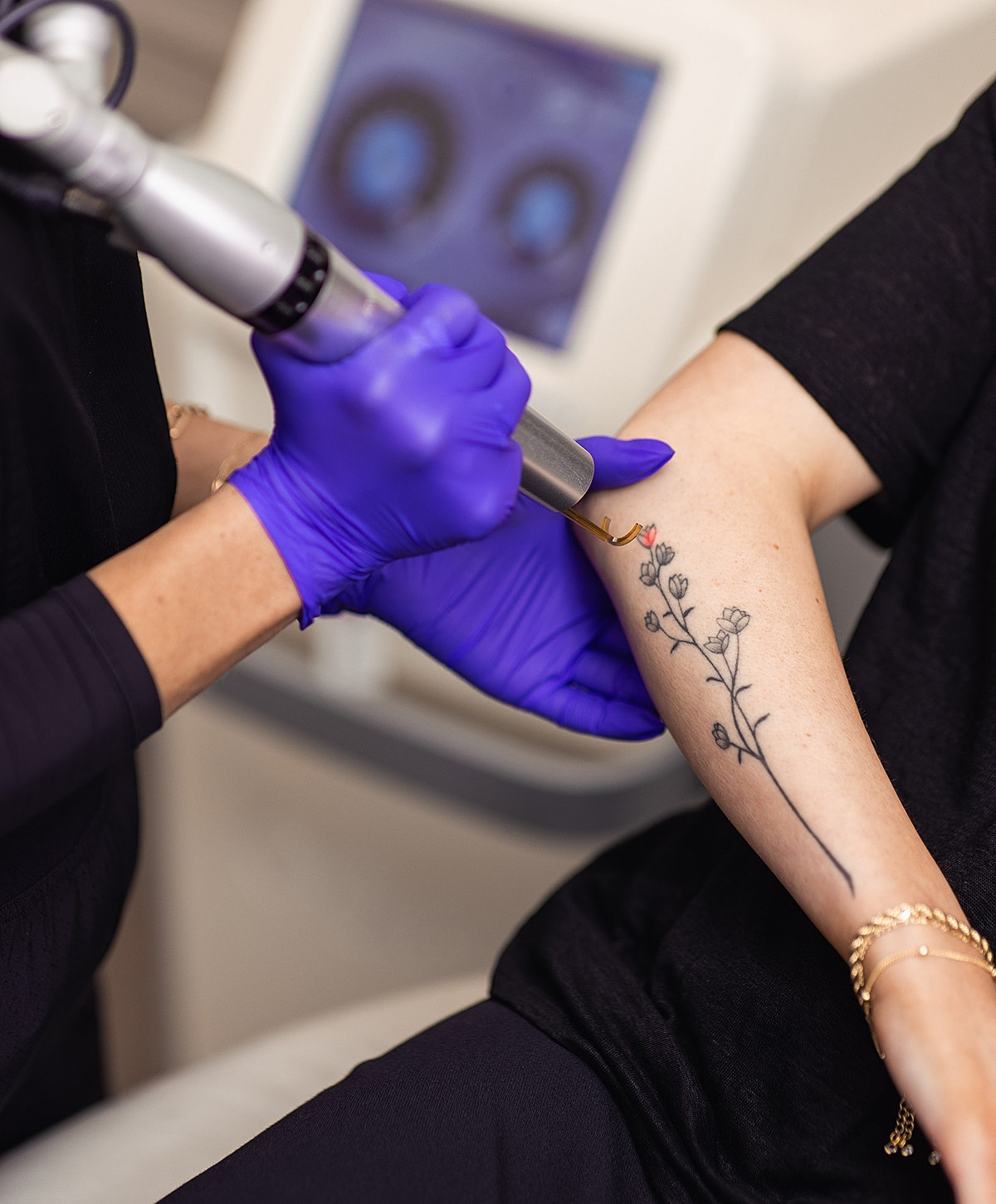 Laser Tattoo Removal Franklin, TN