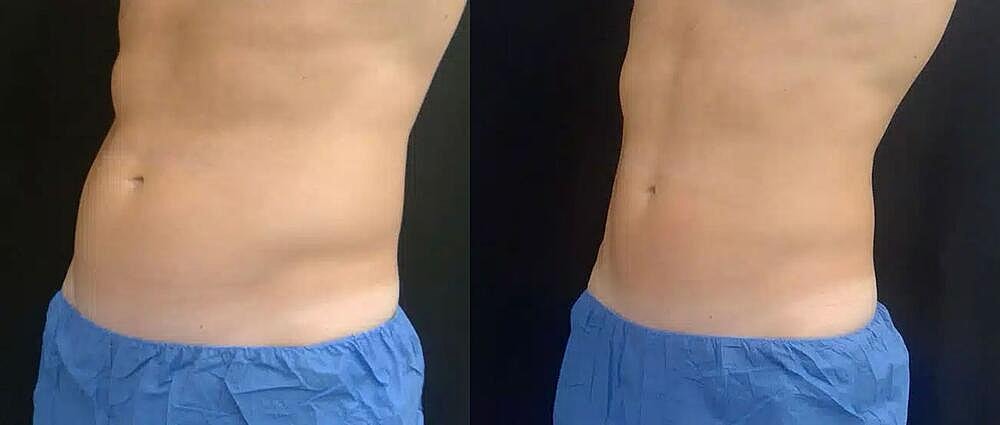 CoolTone Before & After Image