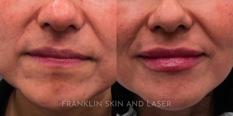 Lip Filler Before & After Image