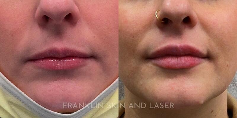 Lip Filler Before & After Image