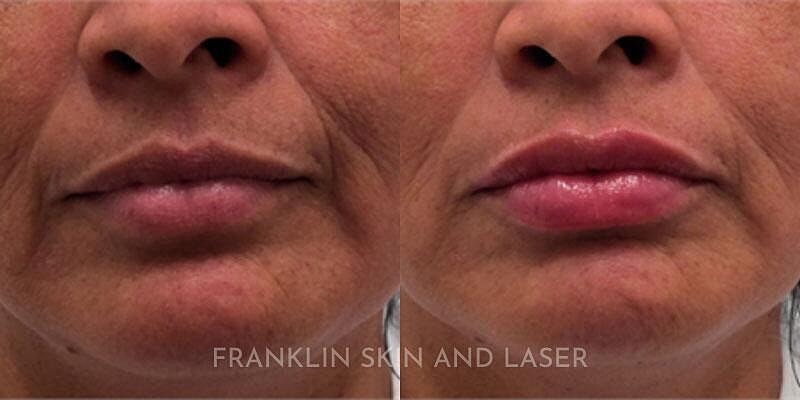 Lip Filler Before & After Image