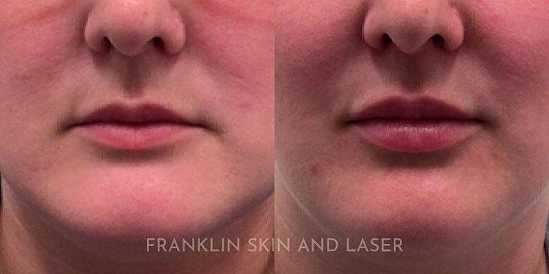 Lip Filler Before & After Image