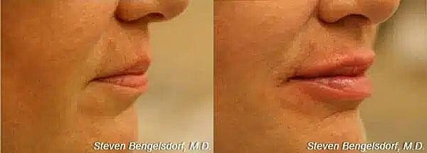 Lip Filler Before & After Image