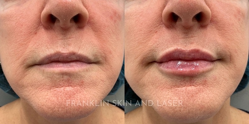 Lip Filler Before & After Image