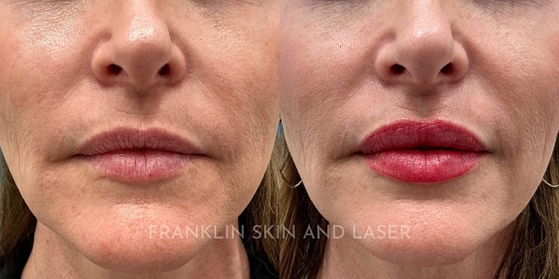 Lip Filler Before & After Image