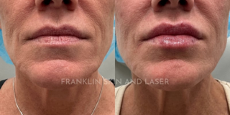 Lip Filler Before & After Image