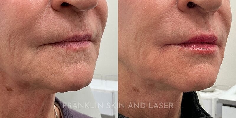 Lip Filler Before & After Image
