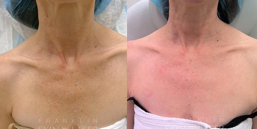 Clear Brilliant Before & After Image