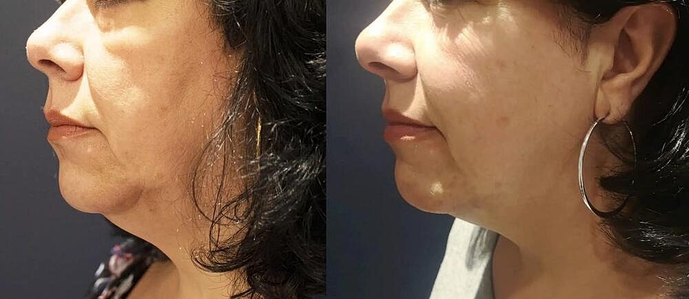 Morpheus8 Face Before & After Image