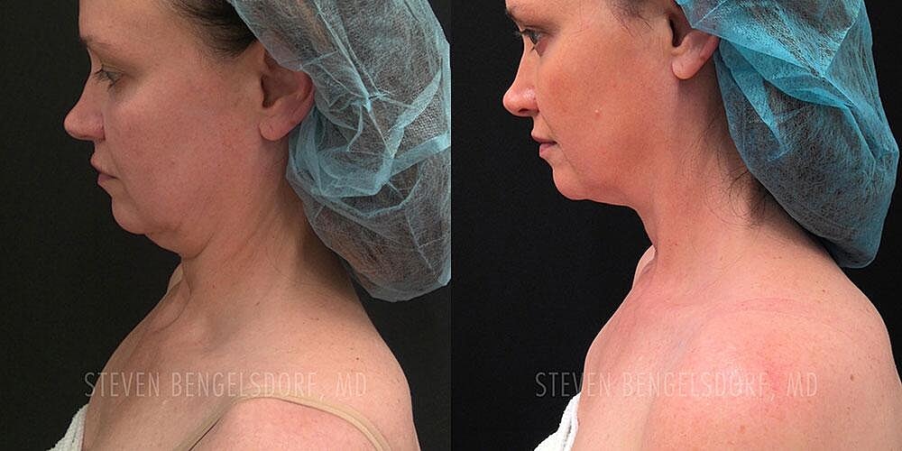Morpheus8 Face Before & After Image