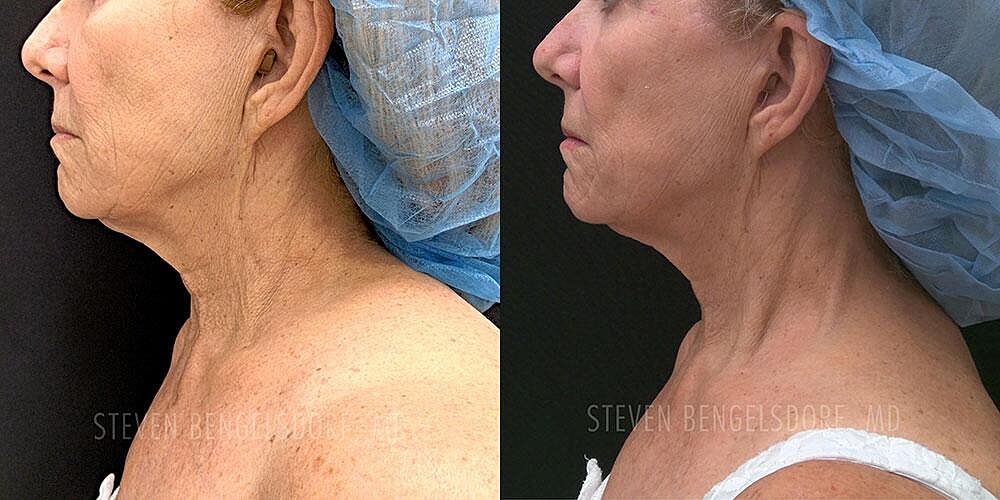 Morpheus8 Face Before & After Image
