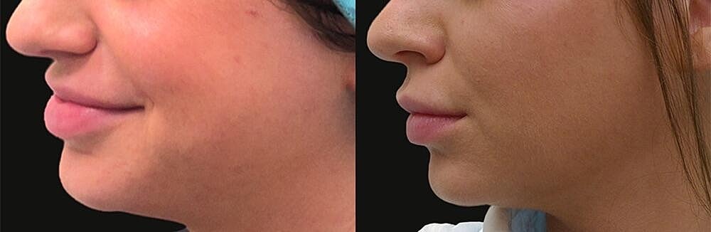 Morpheus8 Face Before & After Image