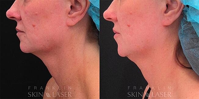Morpheus8 Face Before & After Image