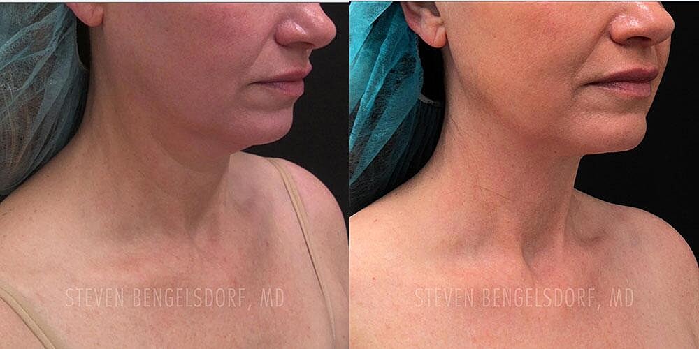 Morpheus8 Face Before & After Image