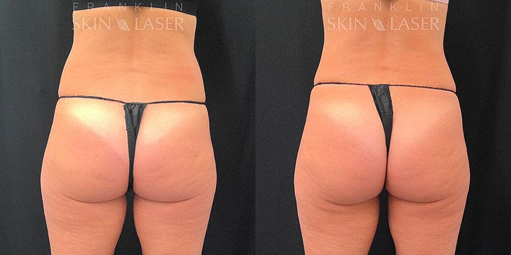 CoolSculpting Before & After Image