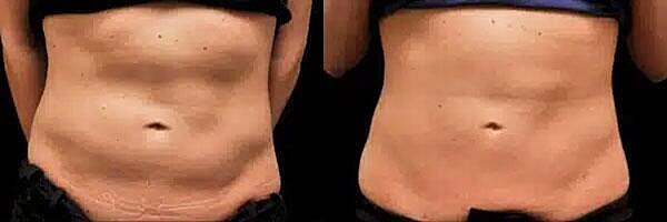 CoolSculpting Before & After Image
