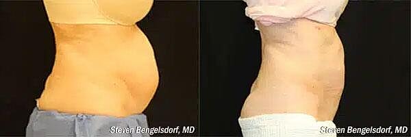 CoolSculpting Before & After Image