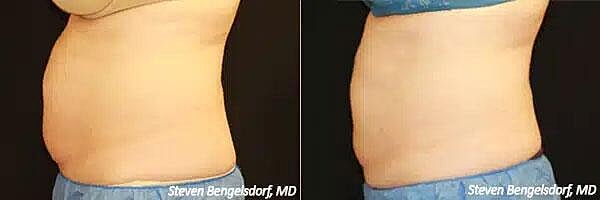 CoolSculpting Before & After Image