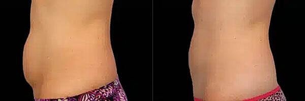 CoolSculpting Before & After Image