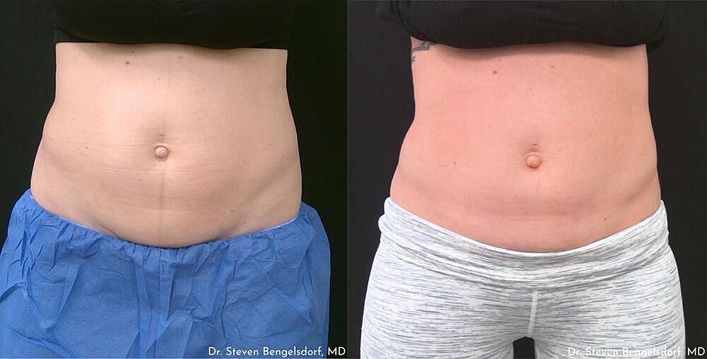 CoolSculpting Before & After Image