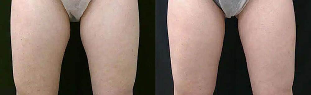 CoolSculpting Before & After Image