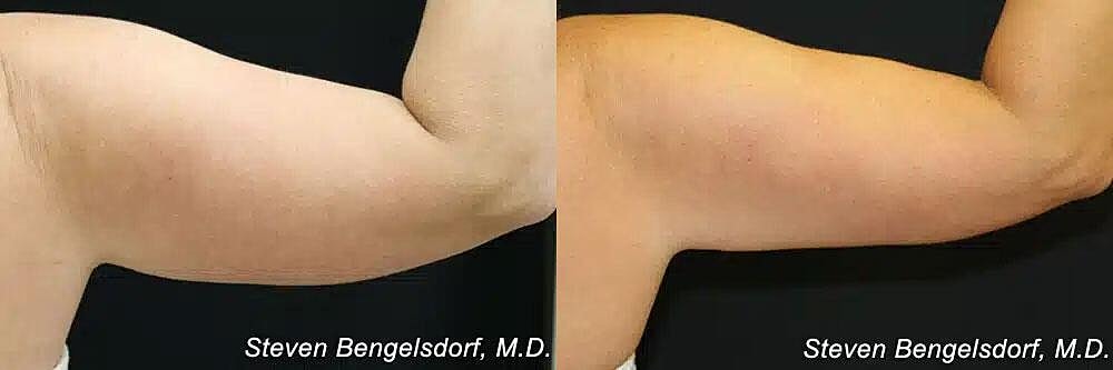 CoolSculpting Before & After Image