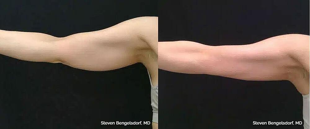 CoolSculpting Before & After Image