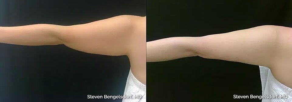 CoolSculpting Before & After Image