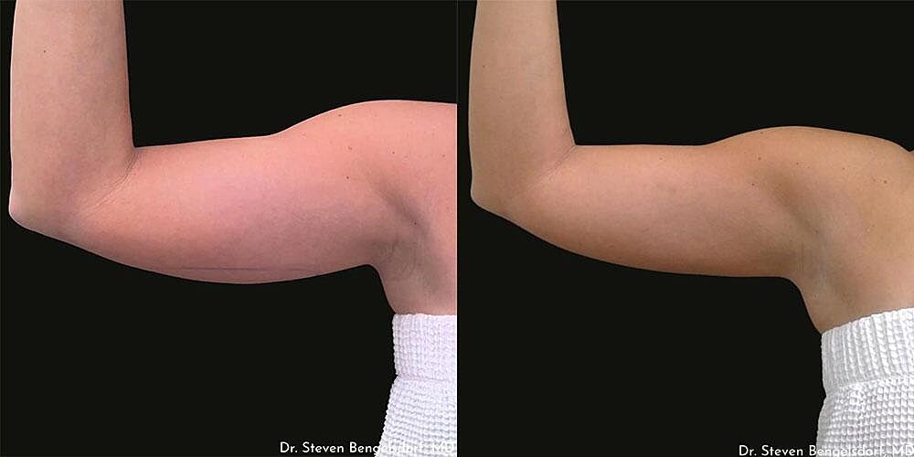 CoolSculpting Before & After Image
