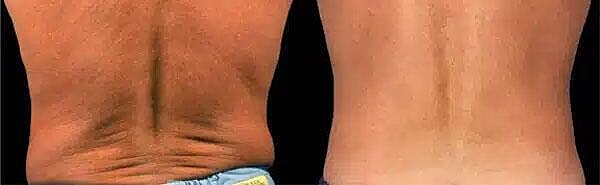 CoolSculpting Before & After Image