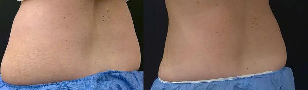 CoolSculpting Before & After Image