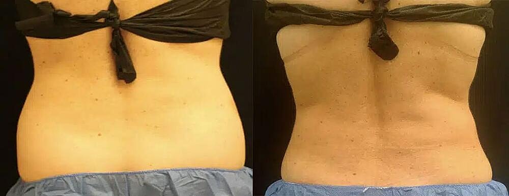 CoolSculpting Before & After Image