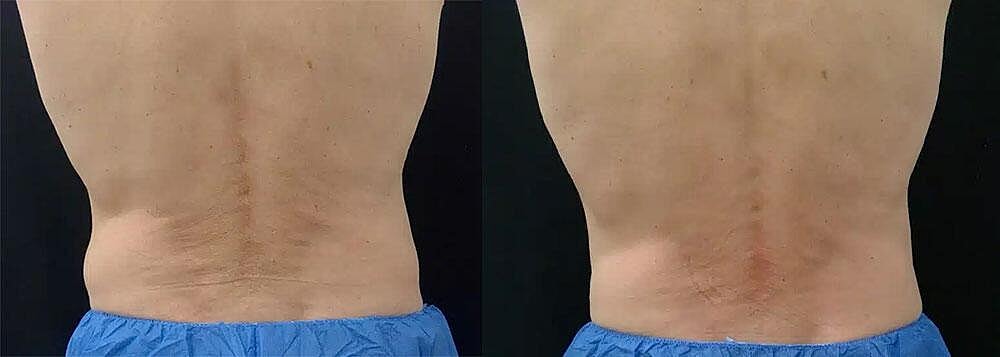 CoolSculpting Before & After Image