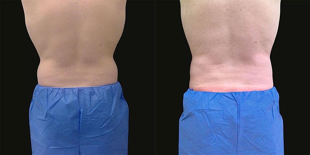 CoolSculpting Before & After Image