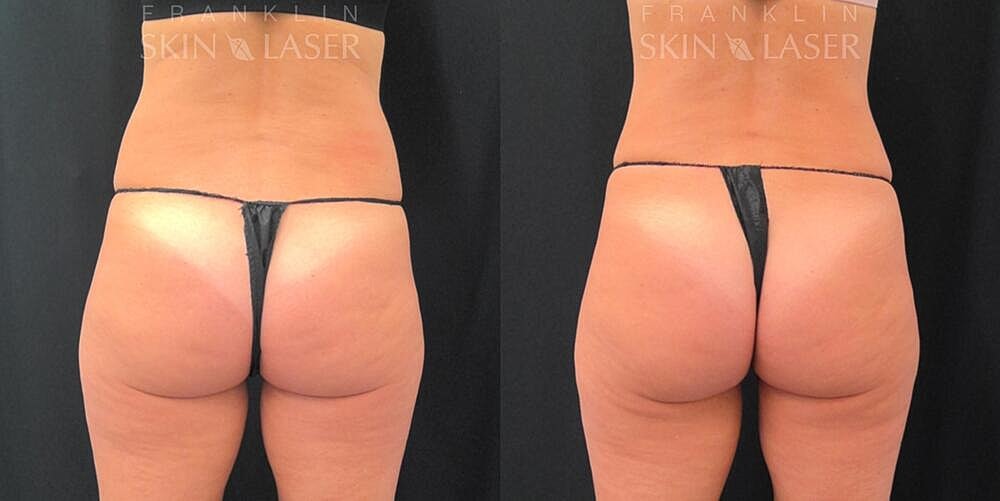CoolSculpting Before & After Image