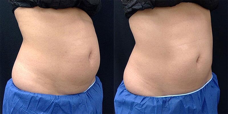 CoolSculpting Before & After Image