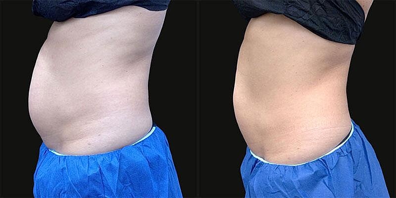 Coolsculpting Before & After