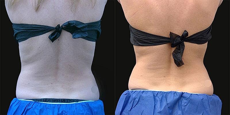Coolsculpting Before & After