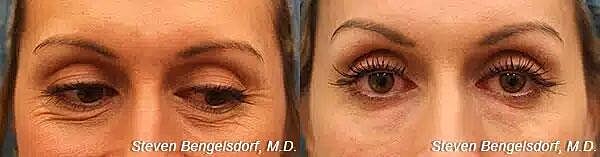 Undereye Fillers Before & After Image