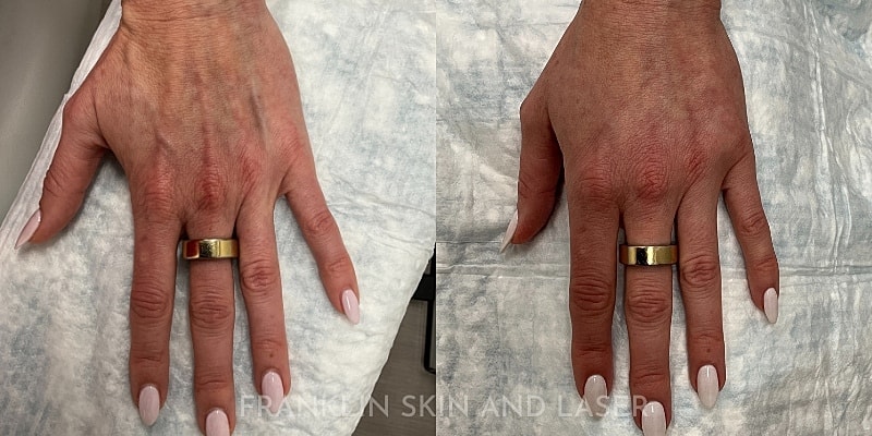 Hand Filler Before & After Image