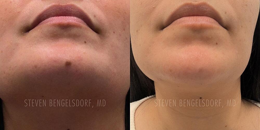 Mole Removal Before & After Image